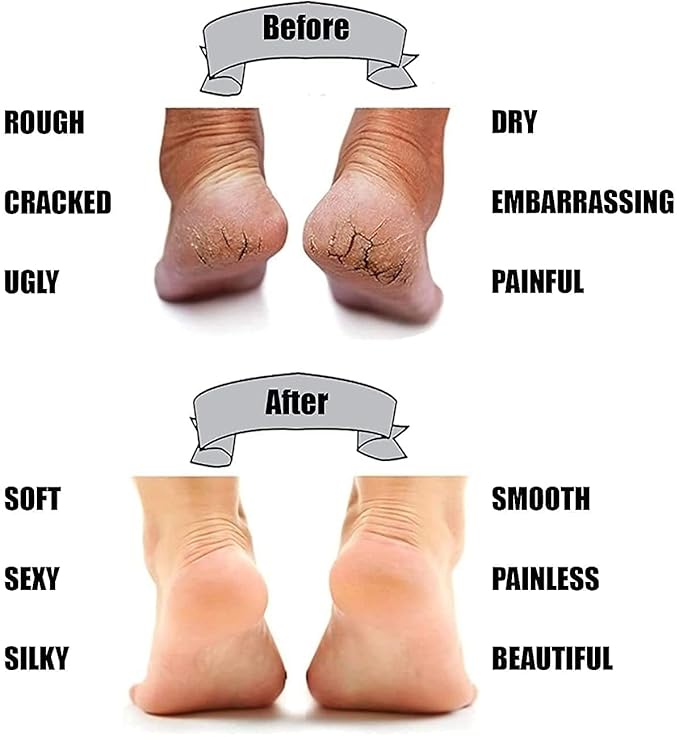 Anti Foot Crack - RashidExpress