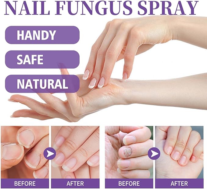 Nail Fungus Spray - RashidExpress